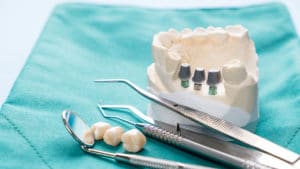 Close-up Implant model tooth support fix bridge implant and crown